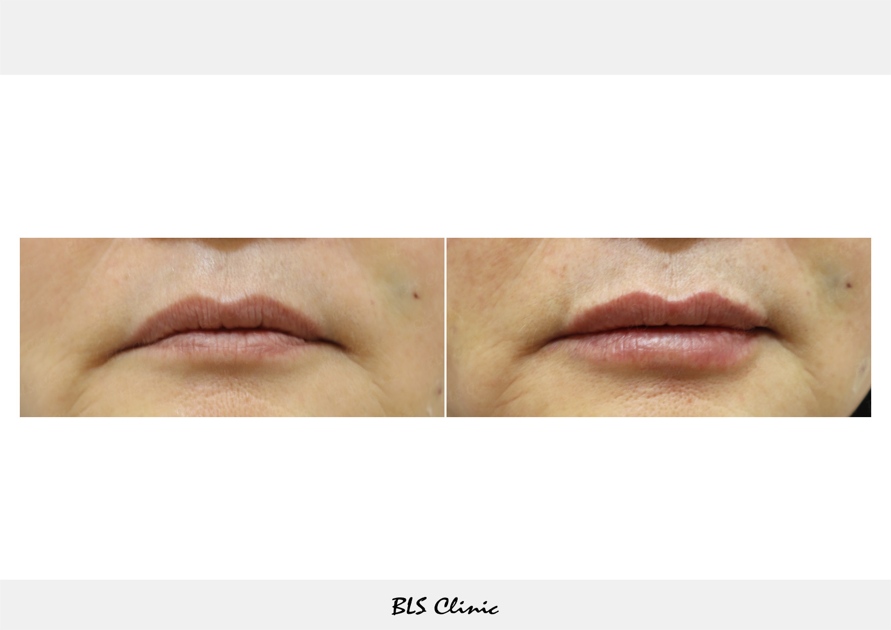 BLS Clinic Gangnam before and after result