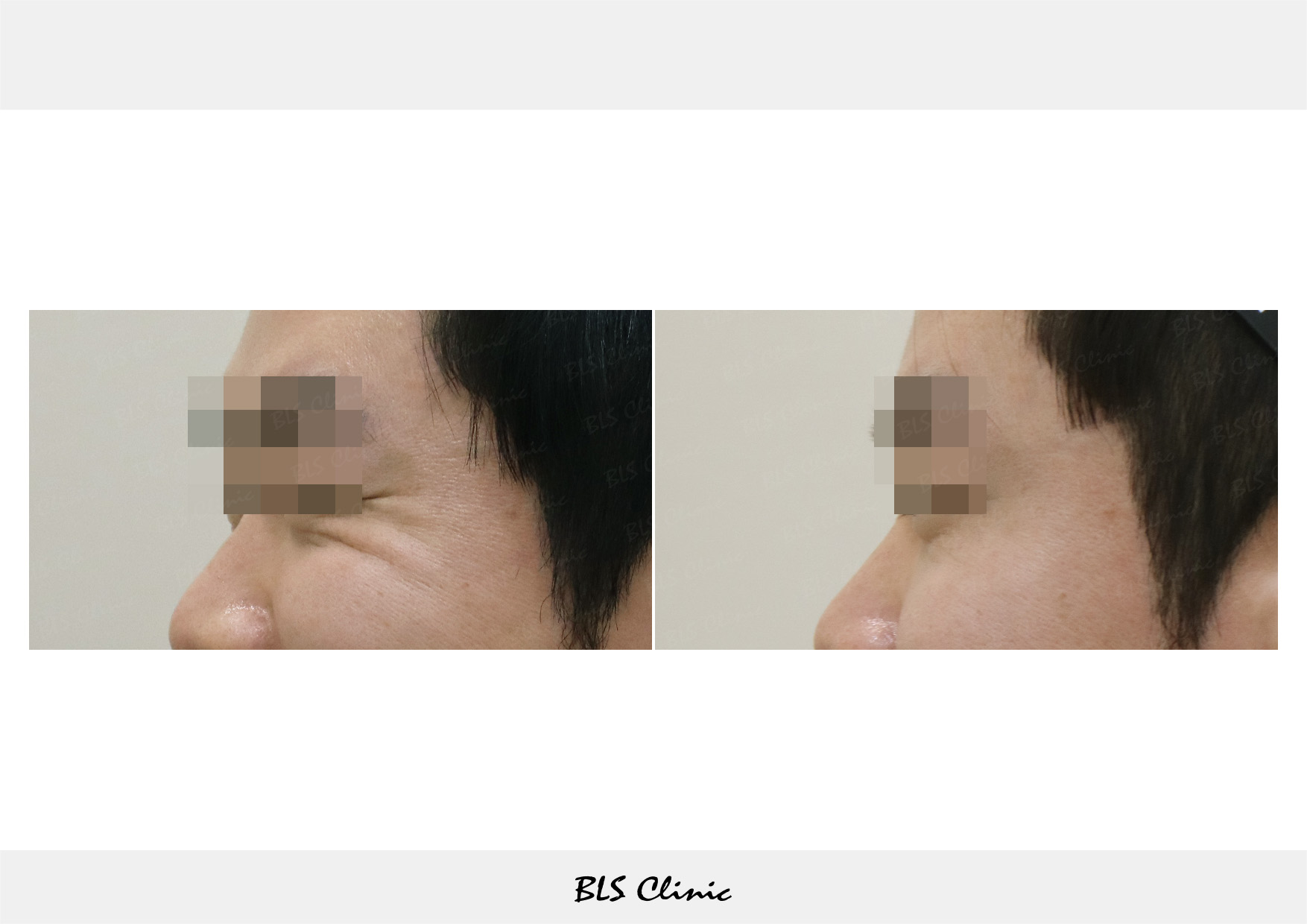 BLS Clinic Gangnam before and after result