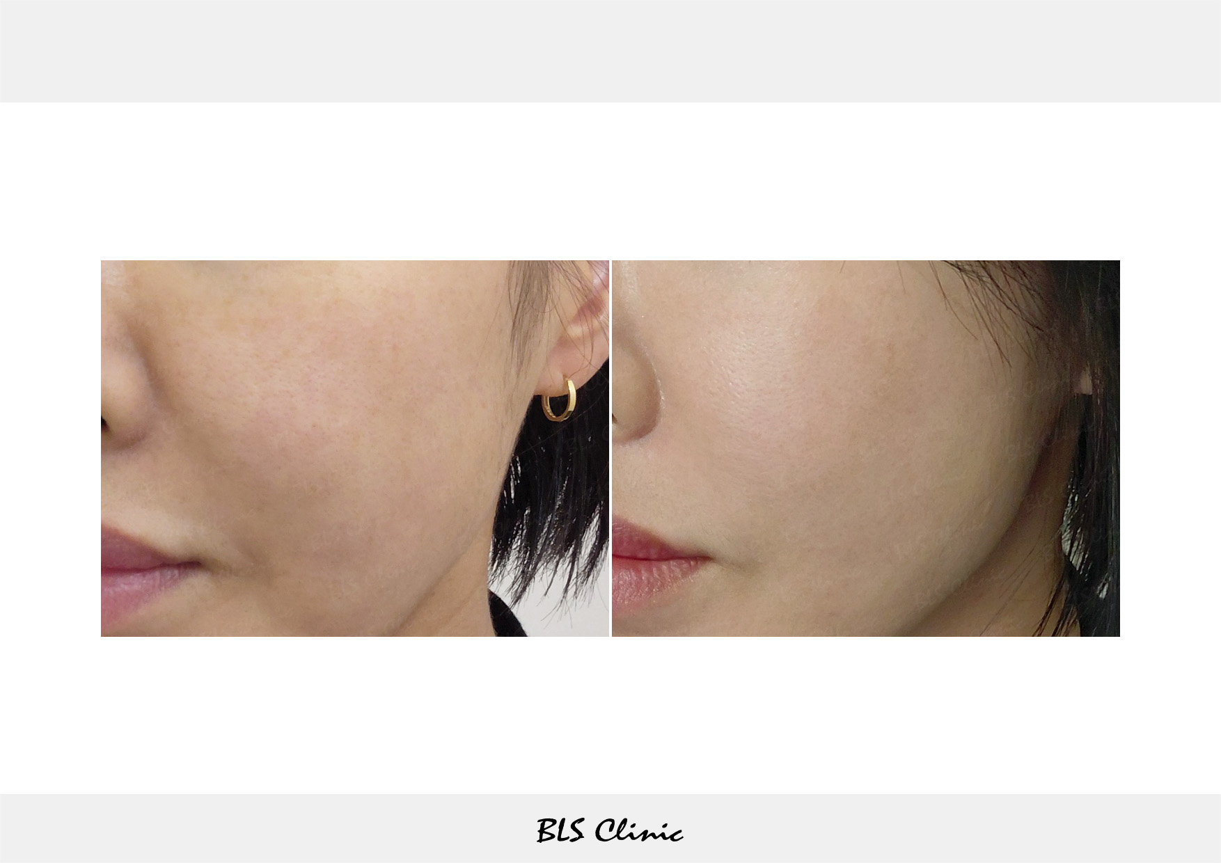 BLS Clinic Gangnam before and after result