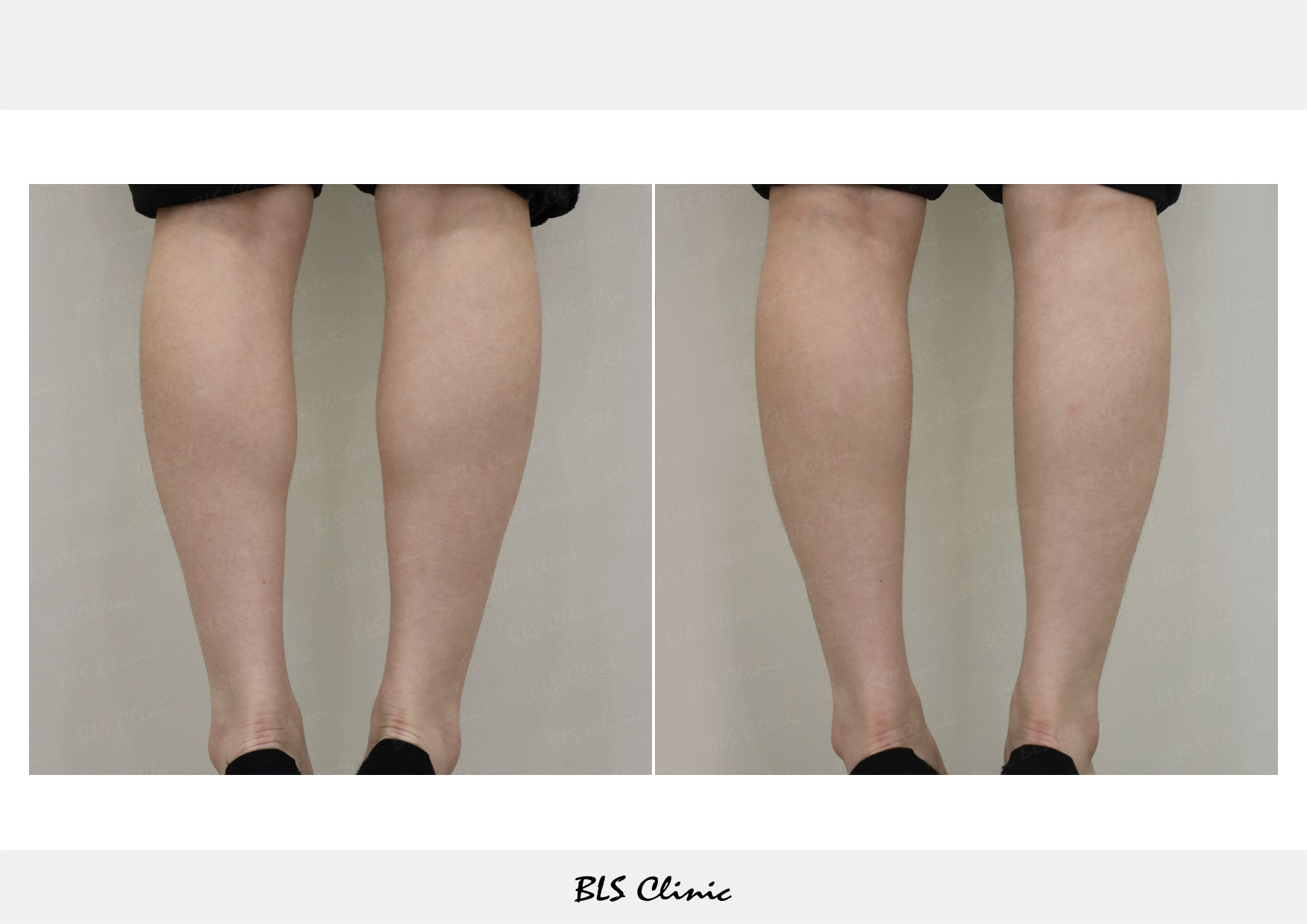BLS Clinic Gangnam before and after result