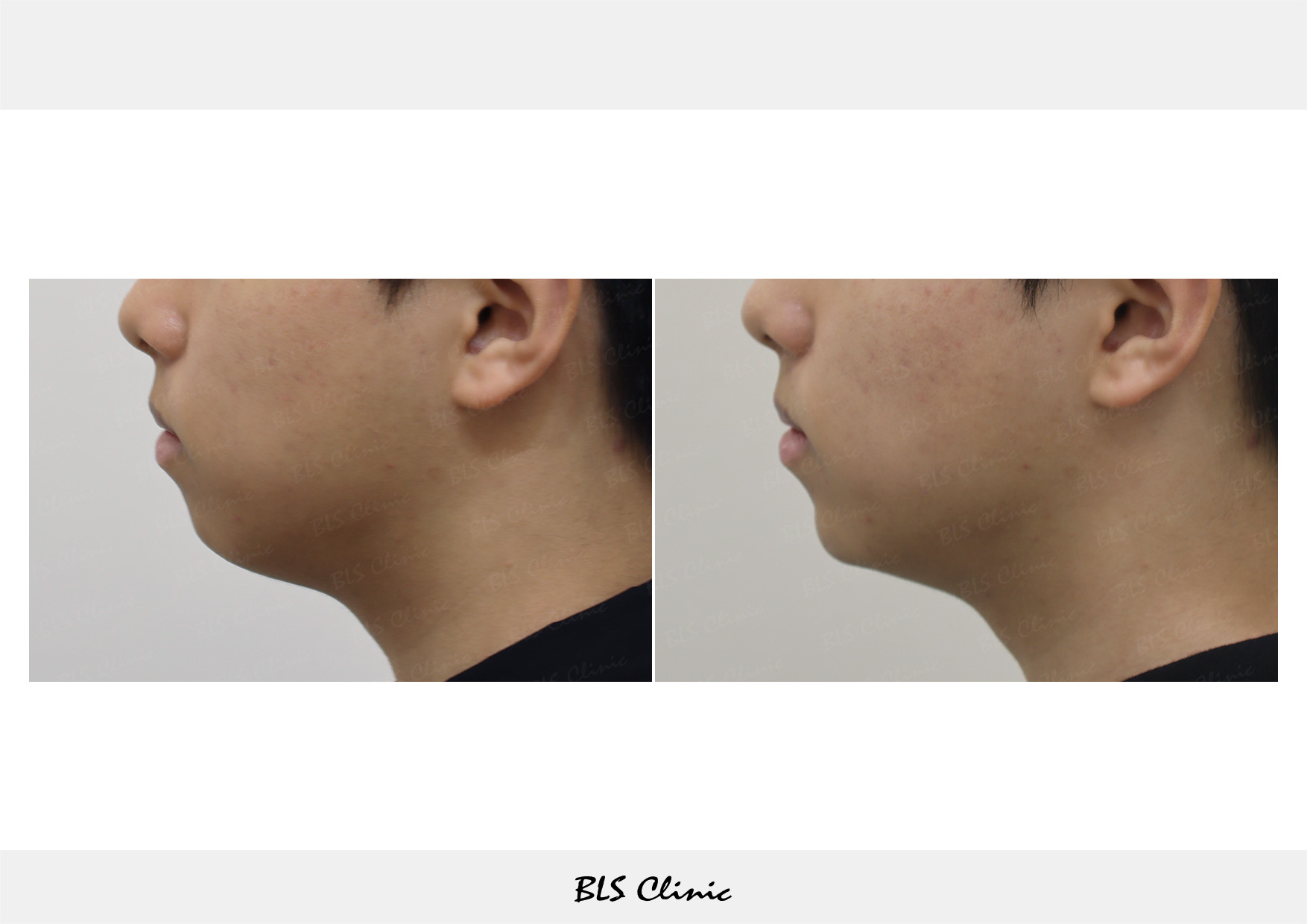 BLS Clinic Gangnam before and after result