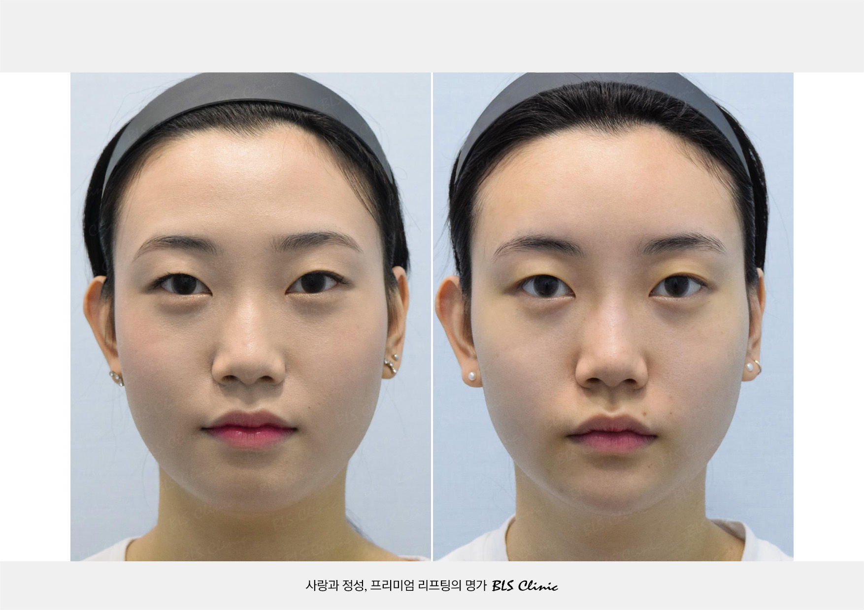 BLS Clinic Gangnam before and after result