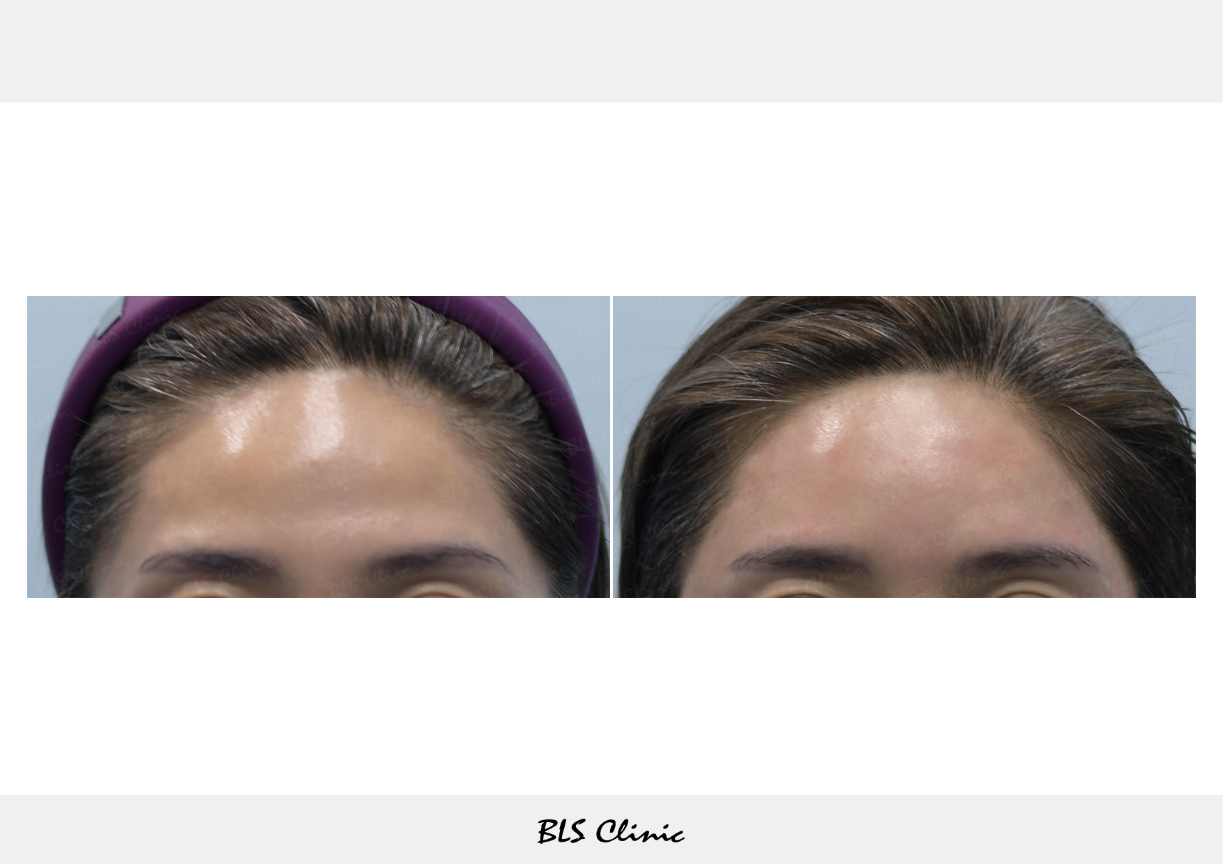 BLS Clinic Gangnam before and after result