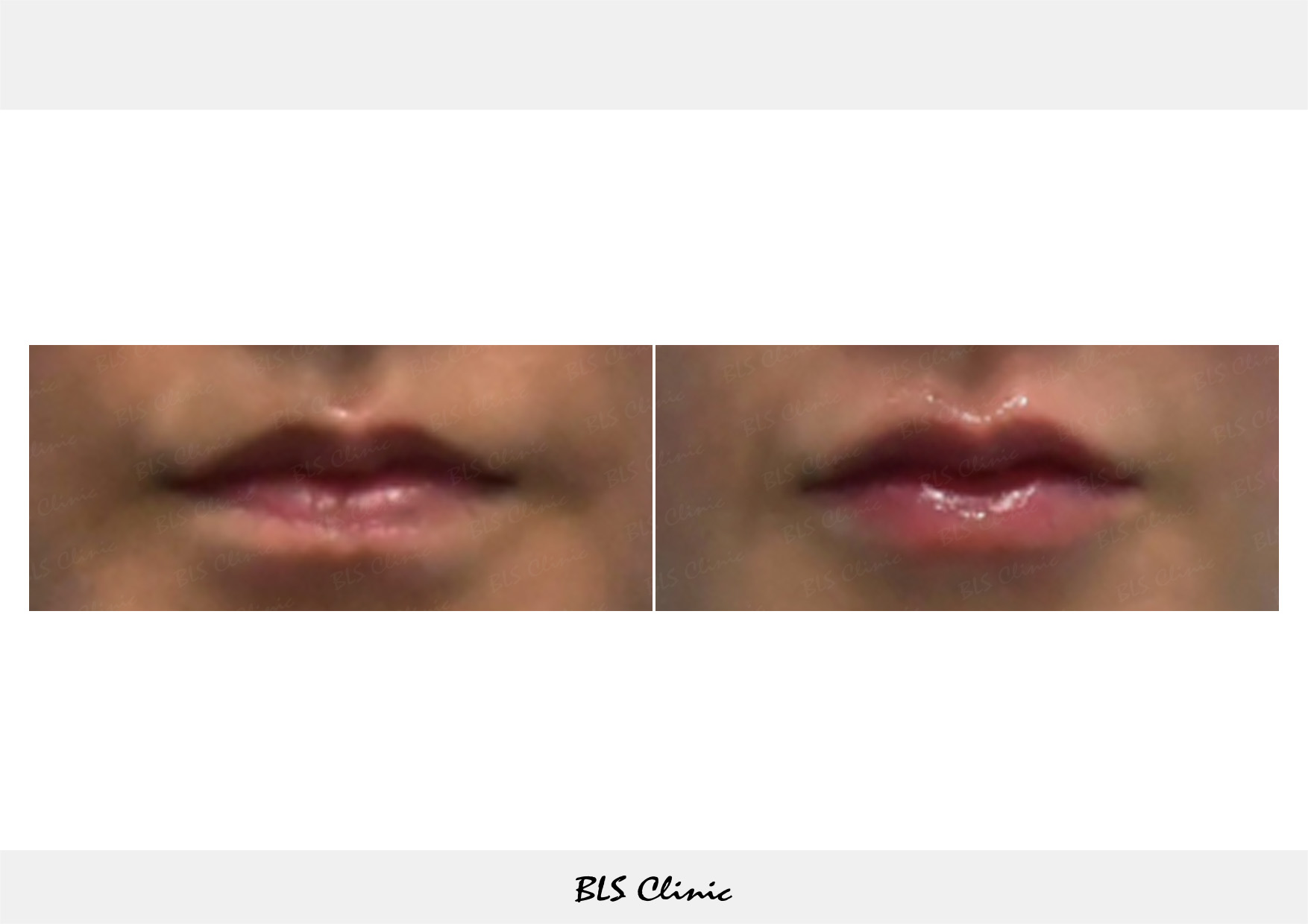BLS Clinic Gangnam before and after result